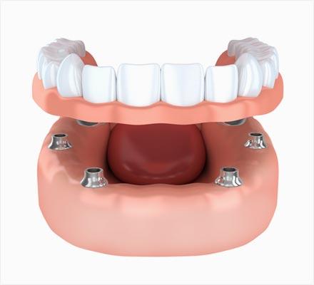 zirconia snap in dentures